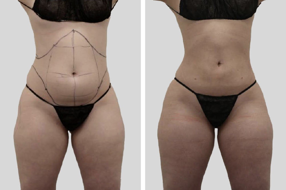 Abdominal Bodytite before and after