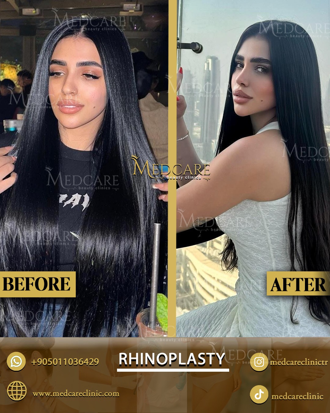 Rhinoplasty before and after
