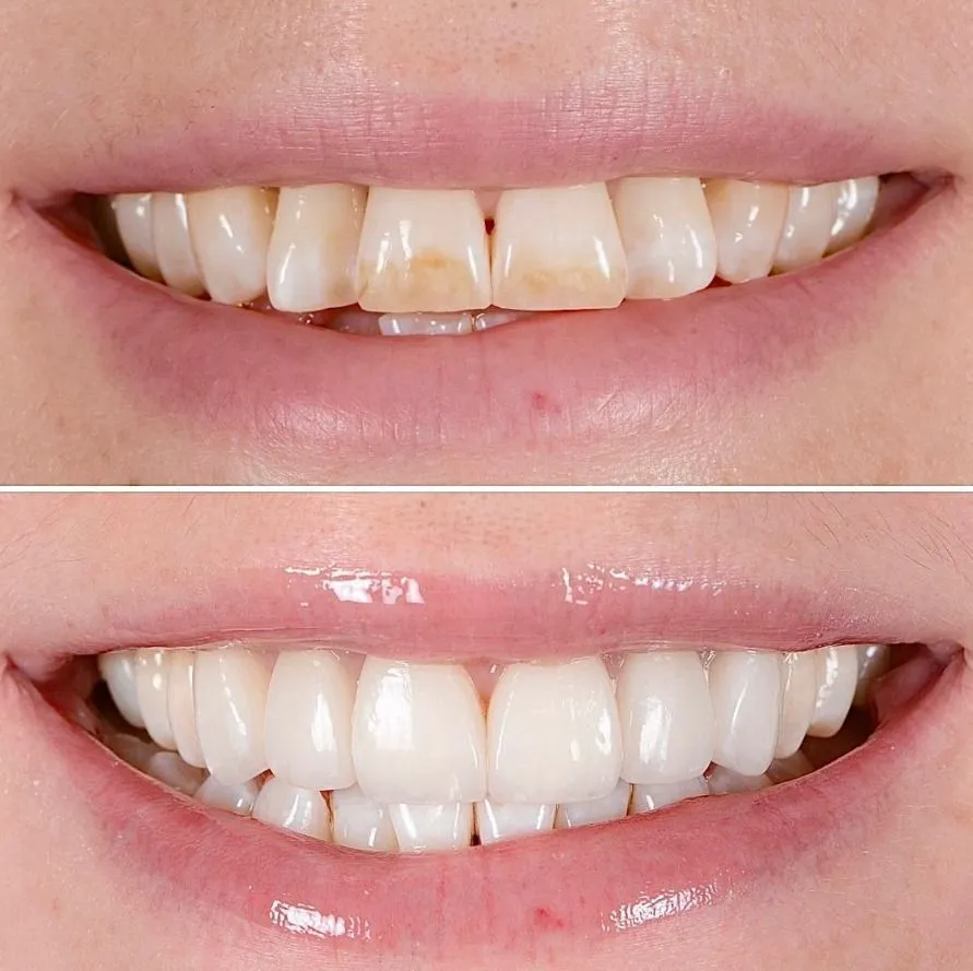 Hollywood Smile before and after