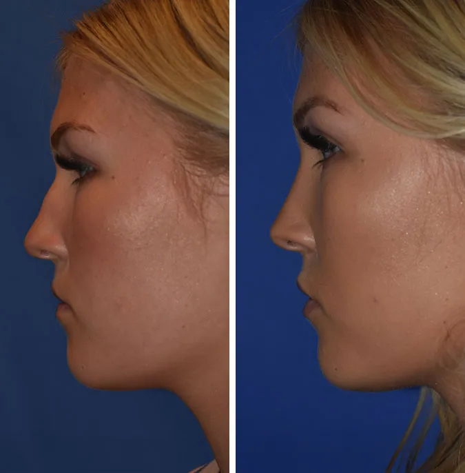 Rhinoplasty before and after