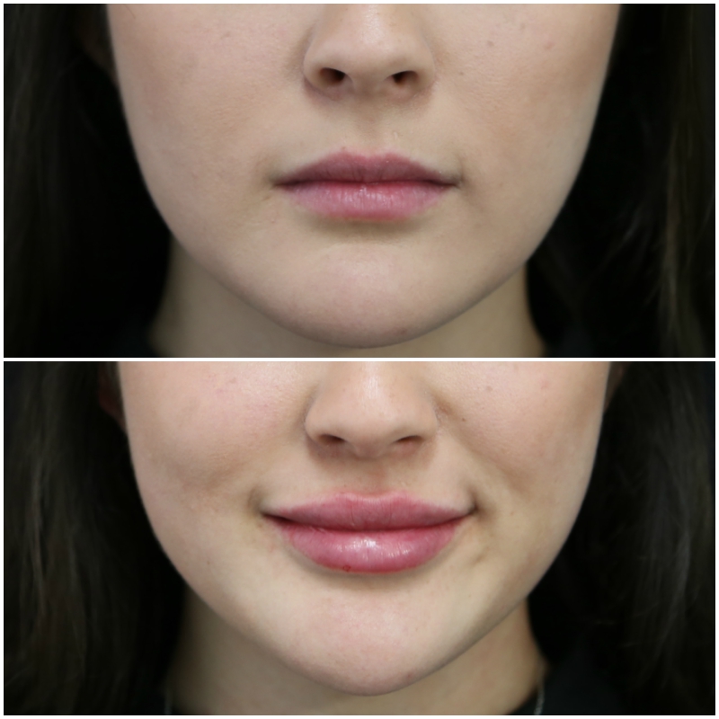 Lip filler before and after
