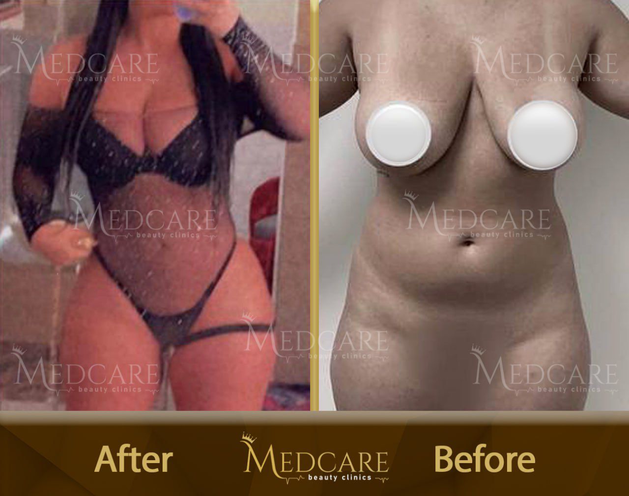 Breast surgery before and after