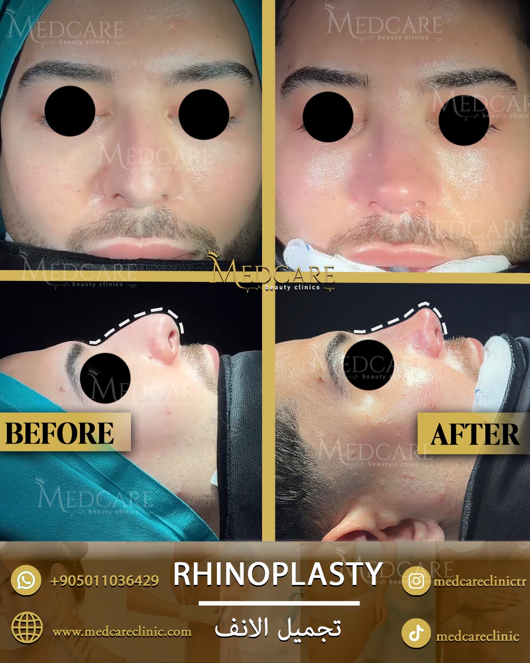 Rhinoplasty before and after