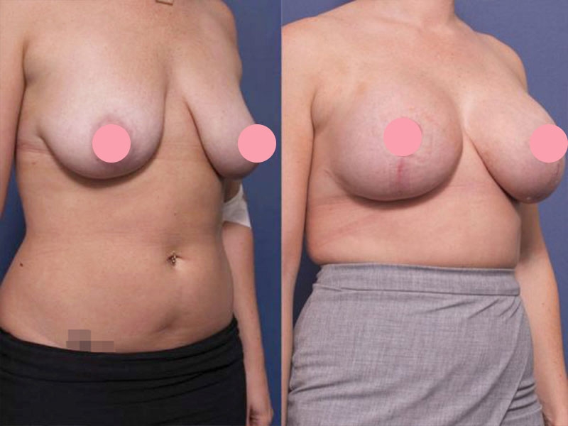 Breast augmentation before and after