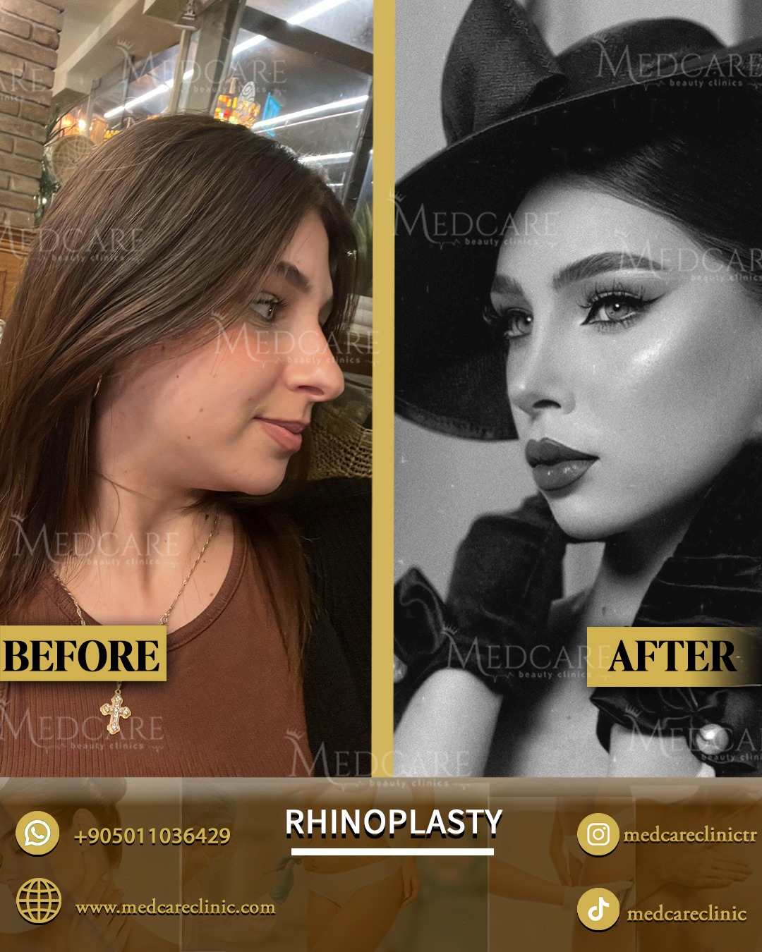 Rhinoplasty before and after