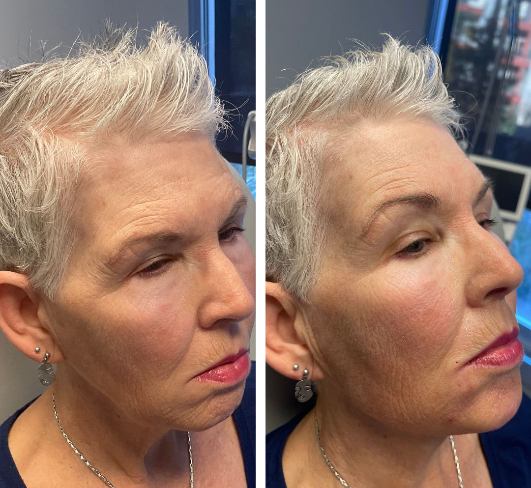 Jawline contouring before and after