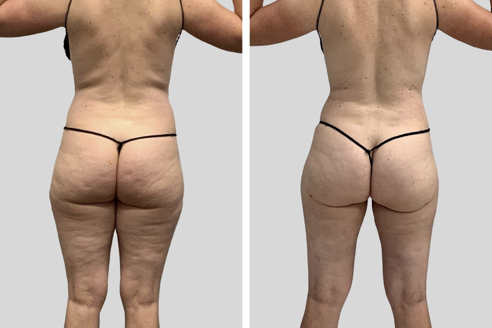 Body contouring before and after