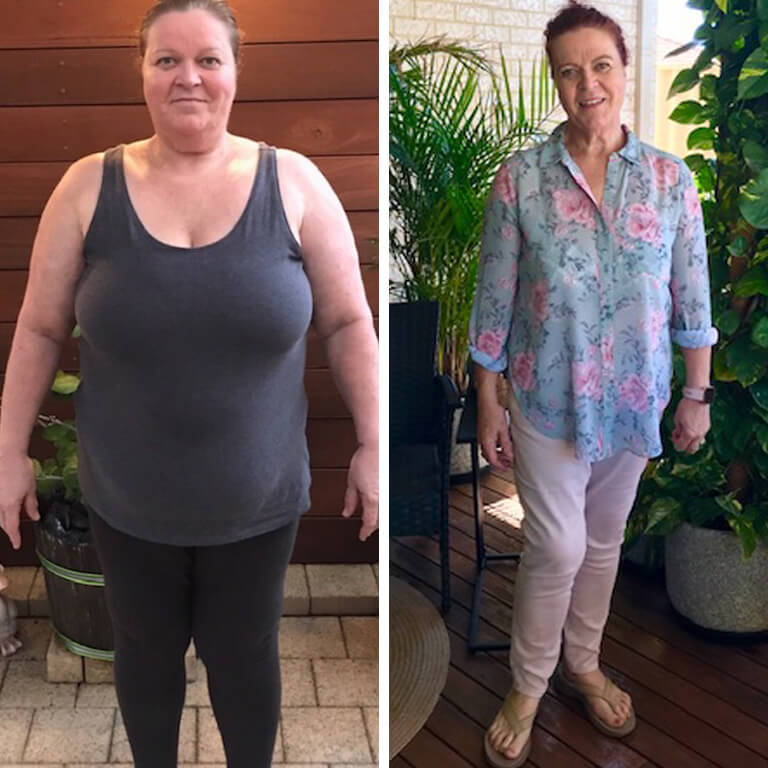 Gastric Sleeve before and after