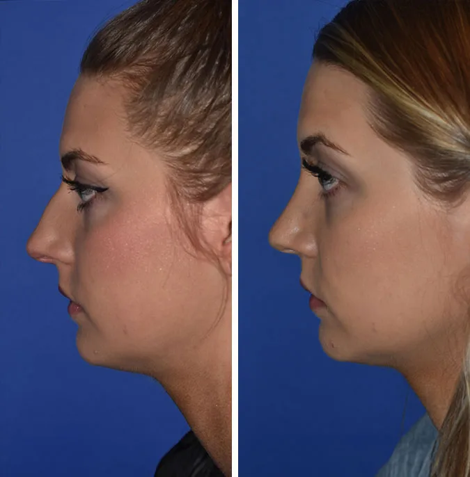 Rhinoplasty before and after