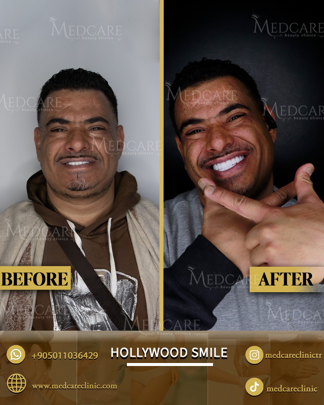 Hollywood Smile before and after