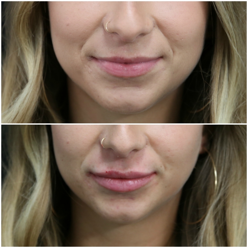 Lip filler before and after