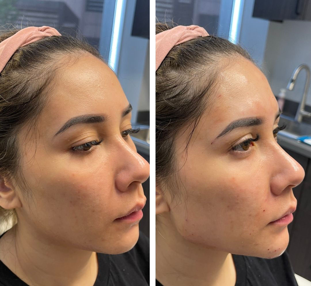 Jawline contouring before and after