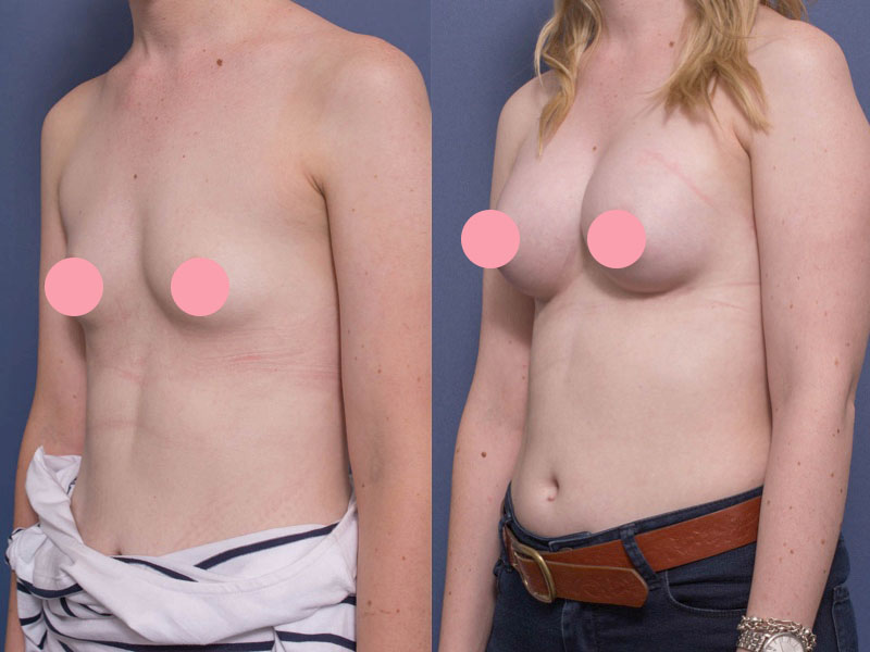 Breast augmentation before and after