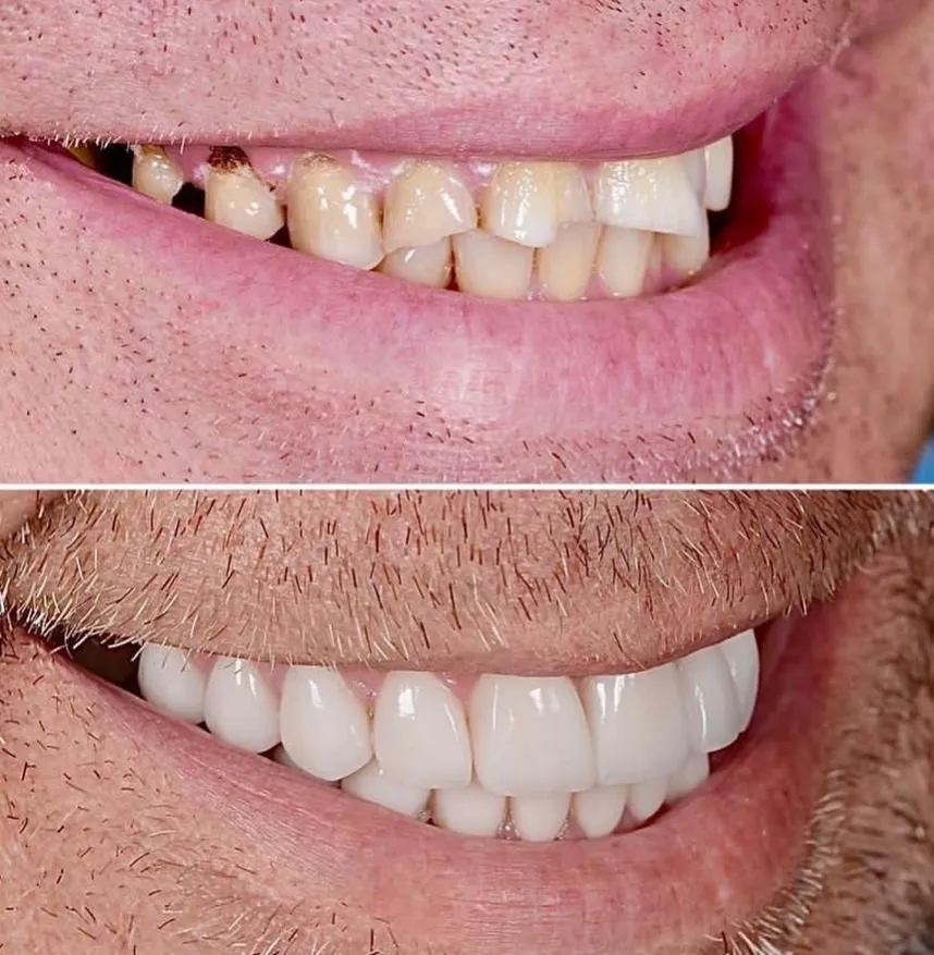 Hollywood Smile before and after