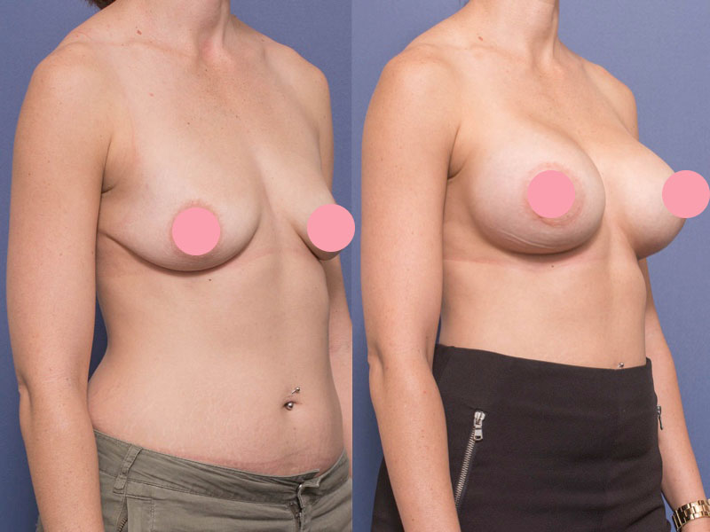 Breast augmentation before and after