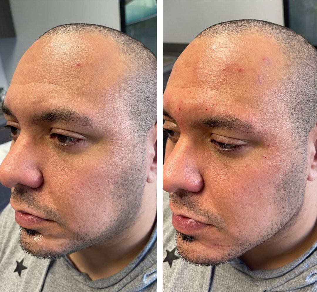Jawline contouring before and after