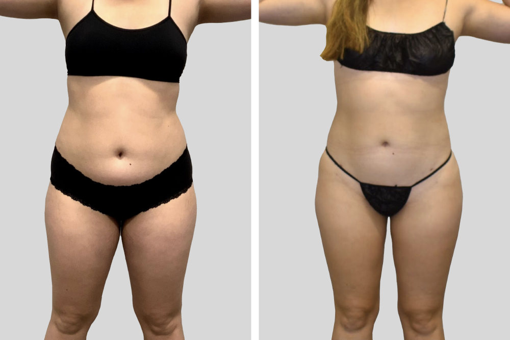 Leg liposuction before and after
