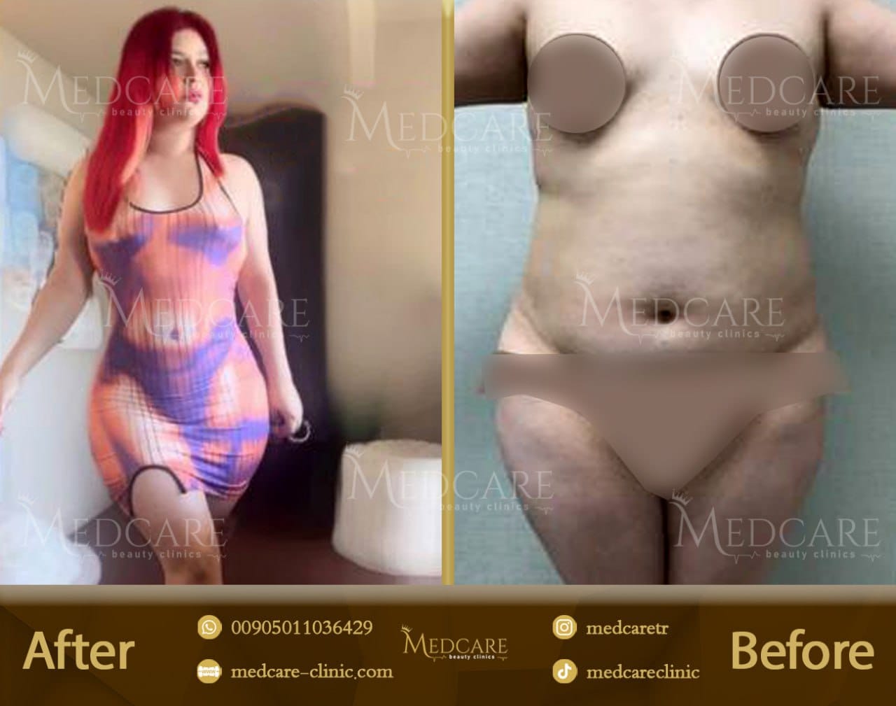 Body contouring before and after