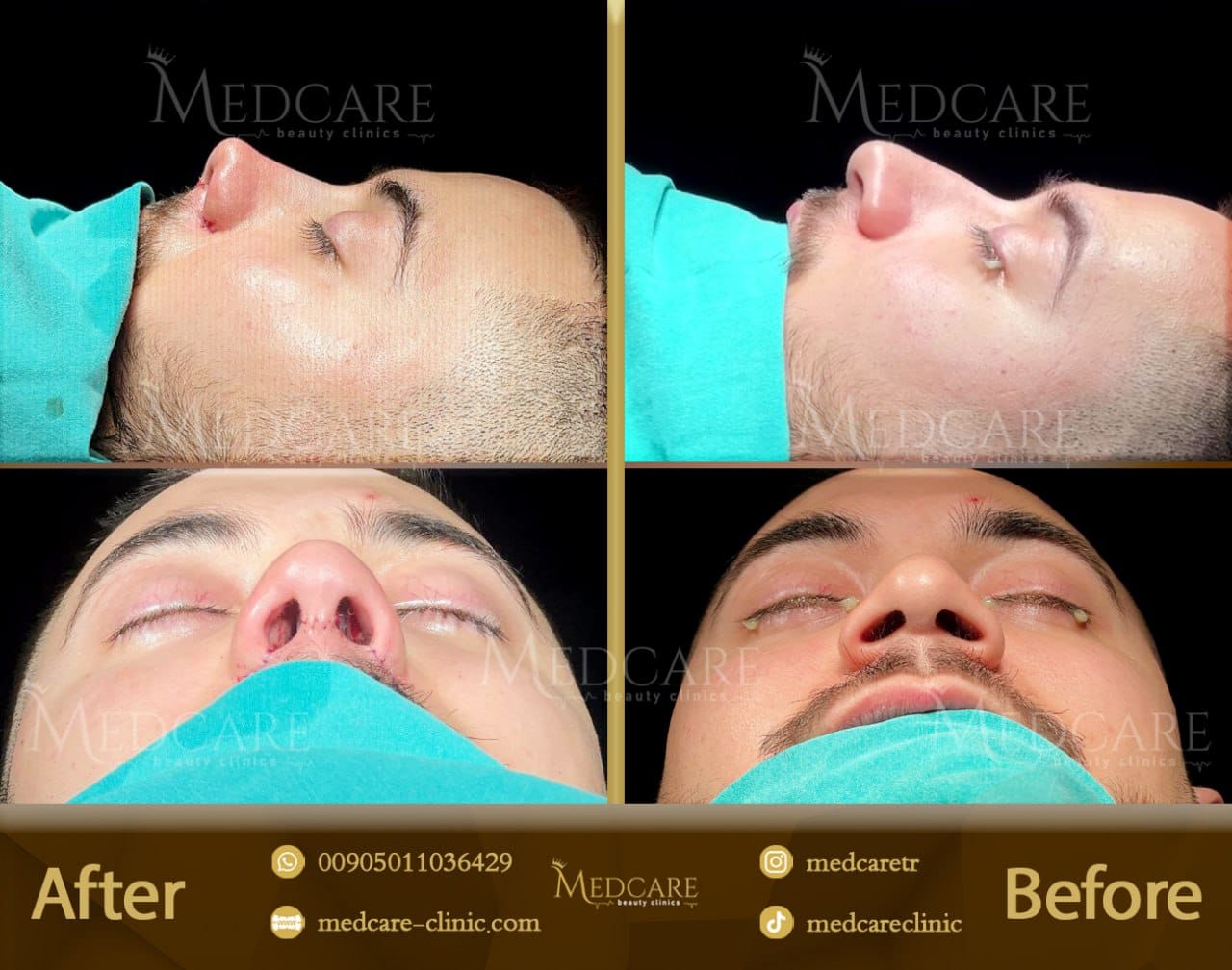 Rhinoplasty before and after