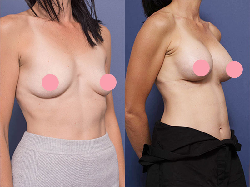 Breast augmentation before and after