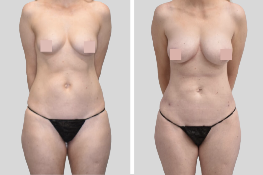 Breast surgery before and after