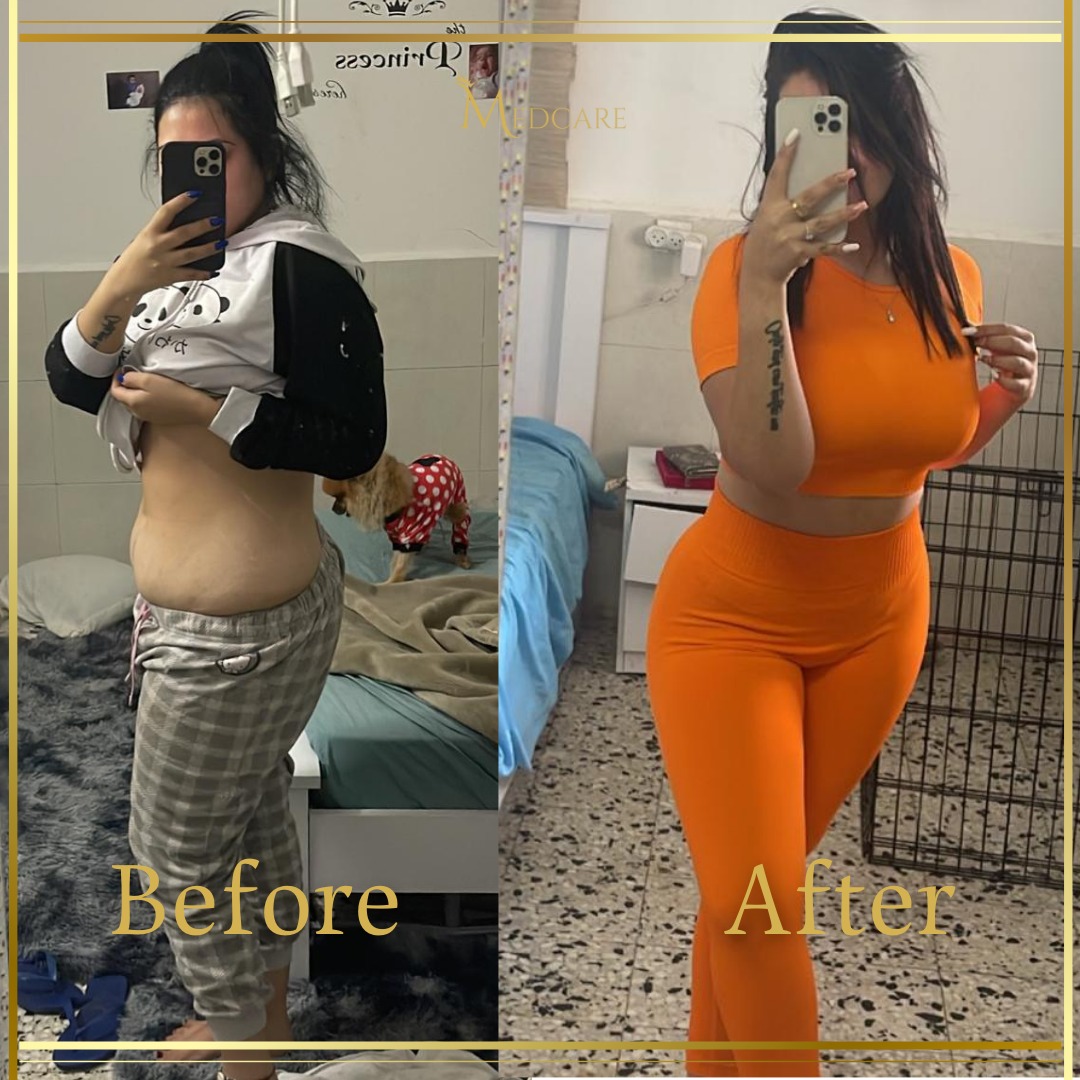 Body contouring before and after