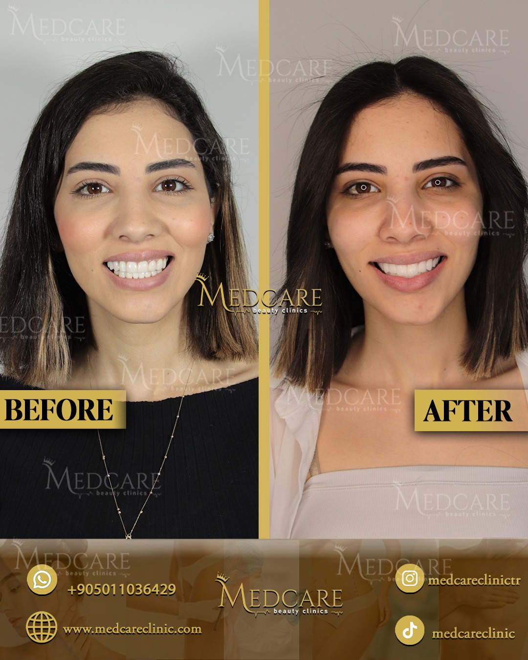 Hollywood Smile before and after