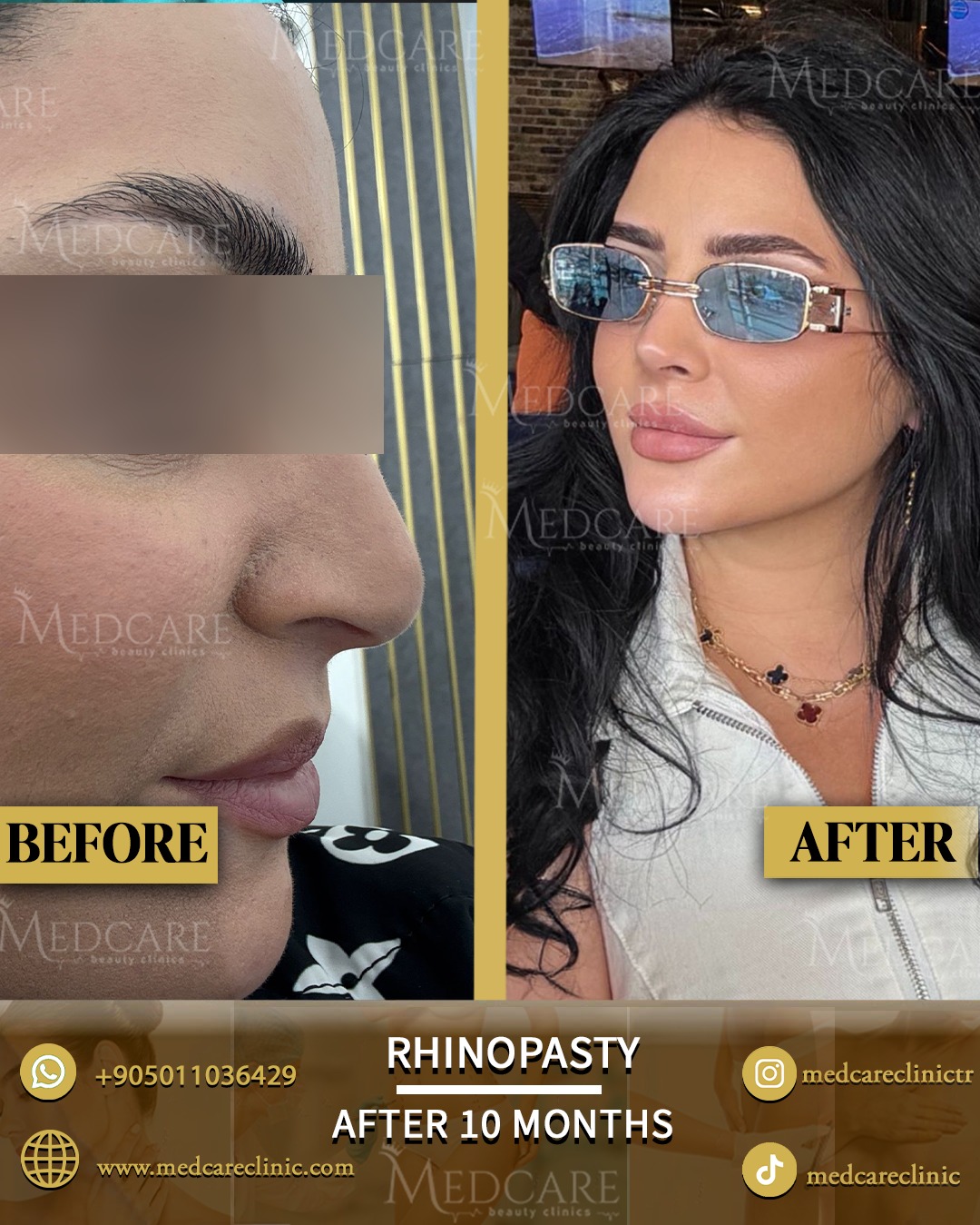 Rhinoplasty before and after