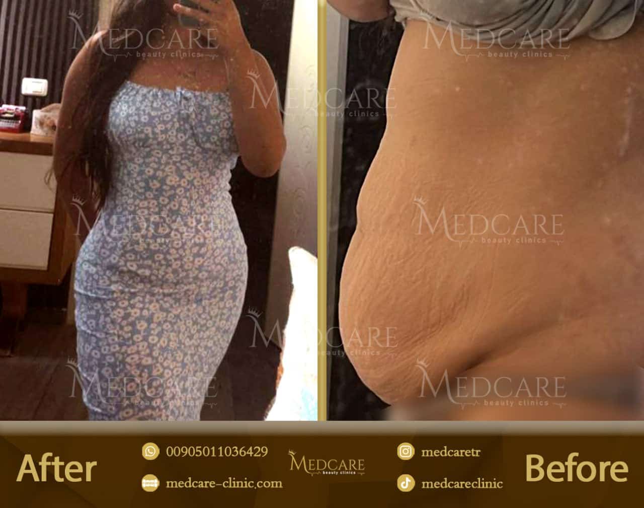 Tummy tuck / liposuction before and after