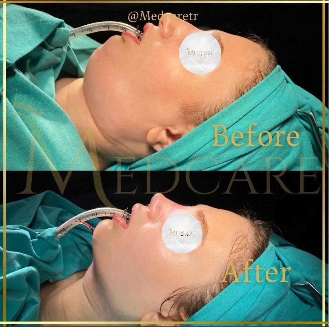 Rhinoplasty before and after