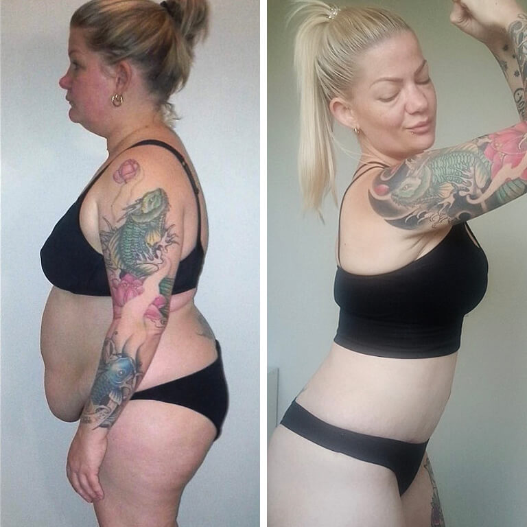 Gastric Sleeve before and after