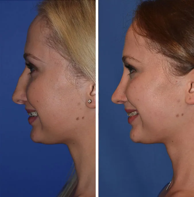 Rhinoplasty before and after