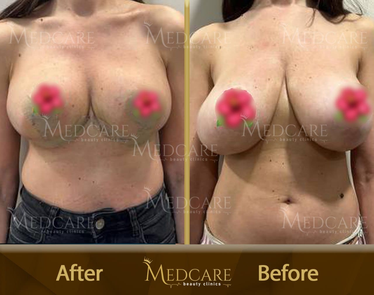 Breast surgery before and after