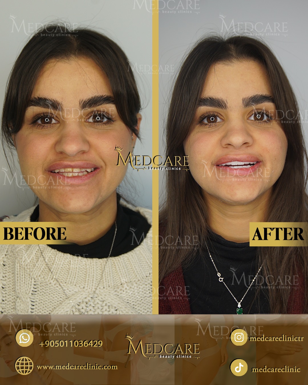 Hollywood Smile before and after