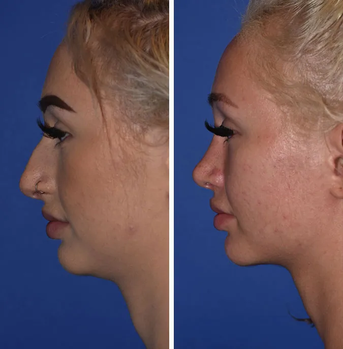 Rhinoplasty before and after