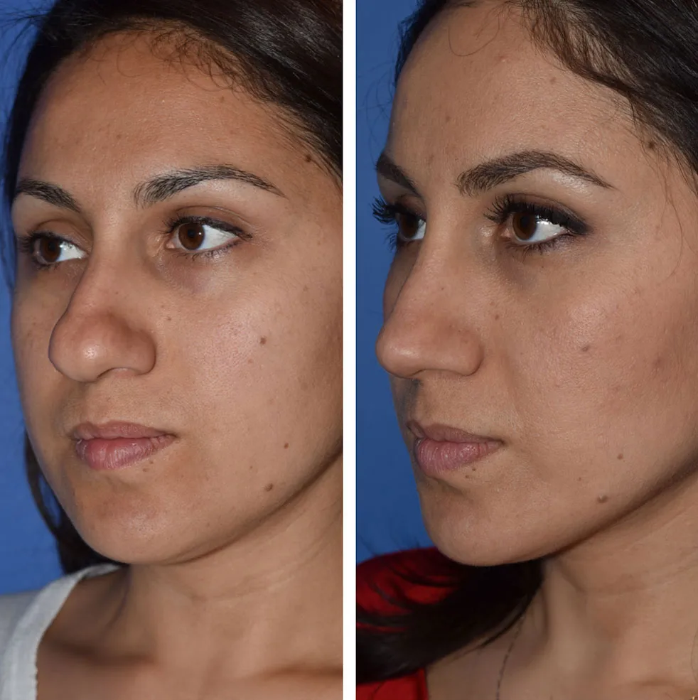 Rhinoplasty before and after