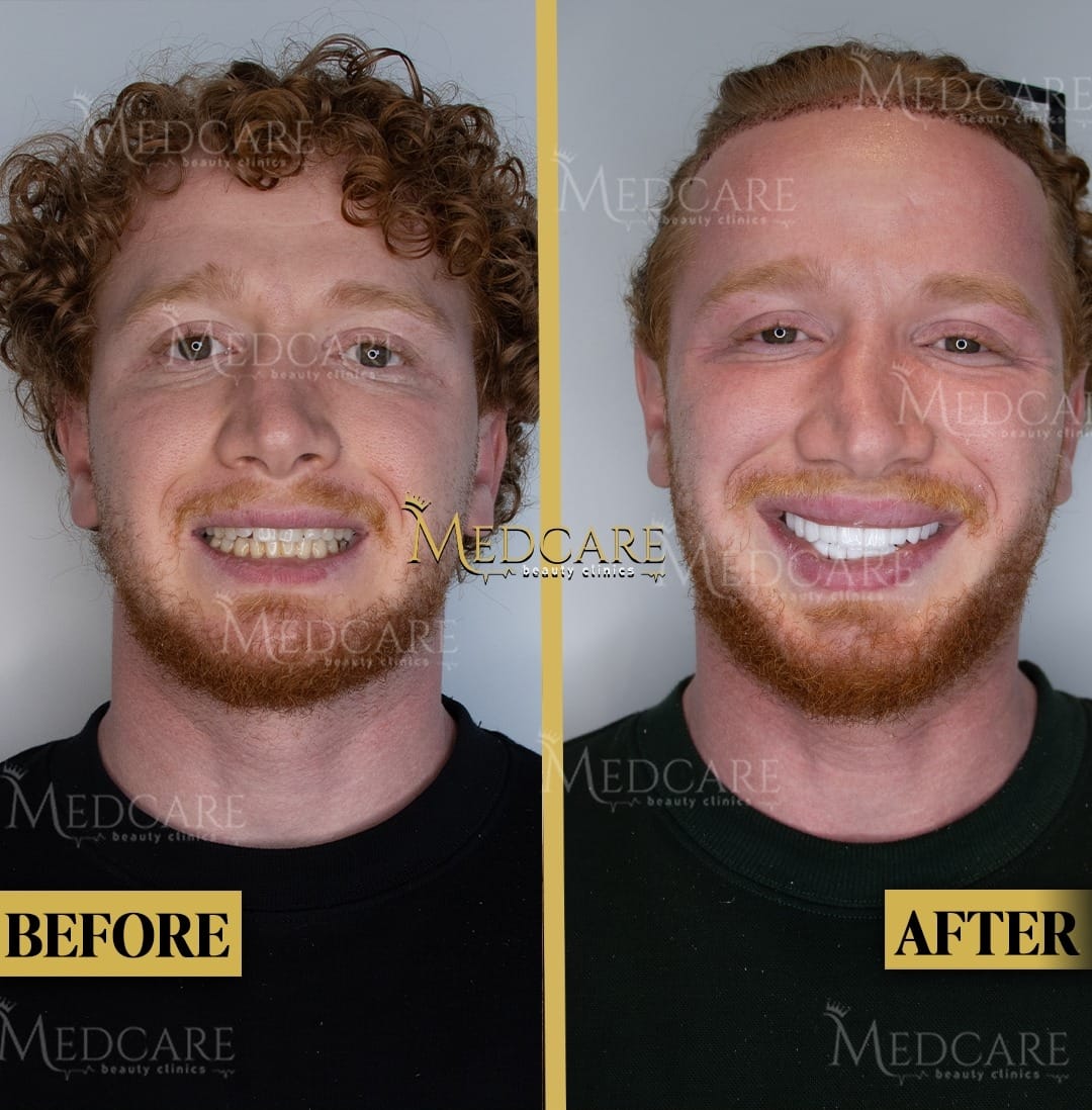 Hair transplant before and after