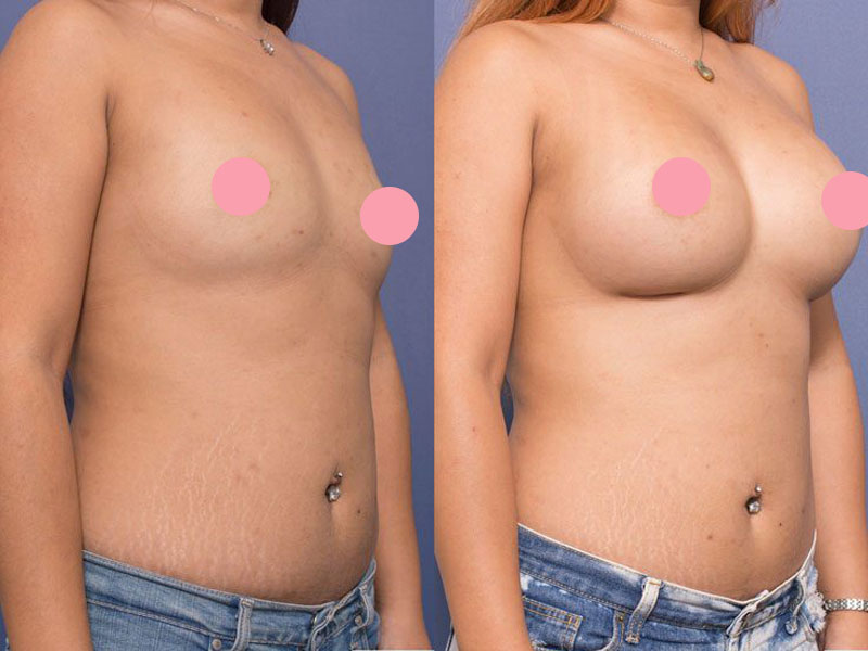 Breast augmentation before and after
