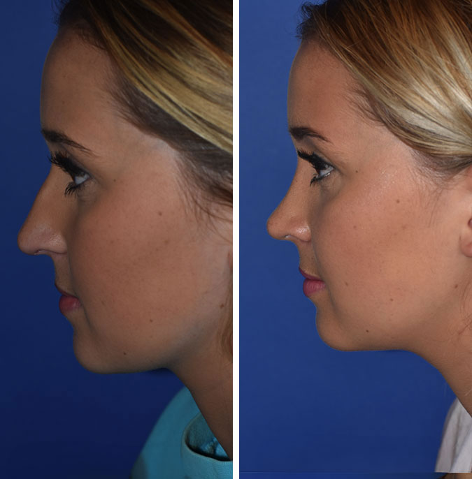 Rhinoplasty before and after