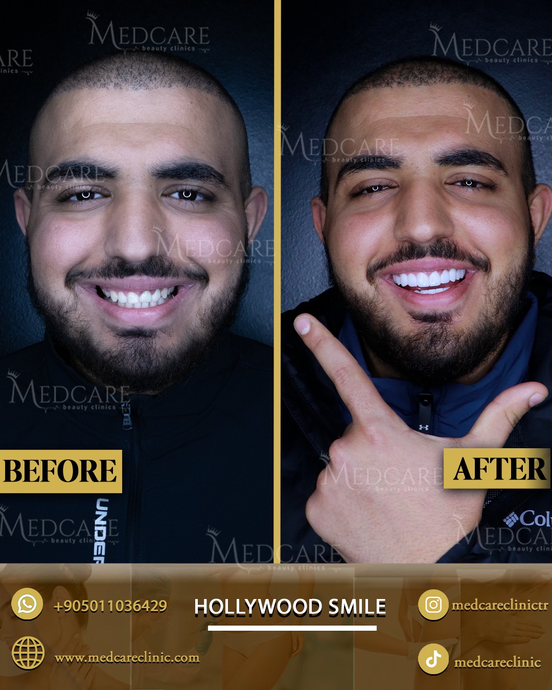 Hollywood Smile before and after