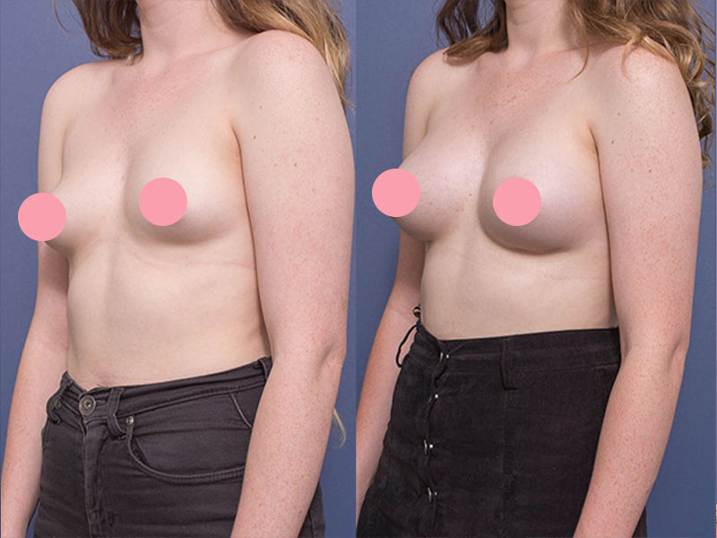 Breast augmentation before and after