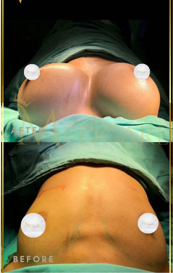 BBL before and after